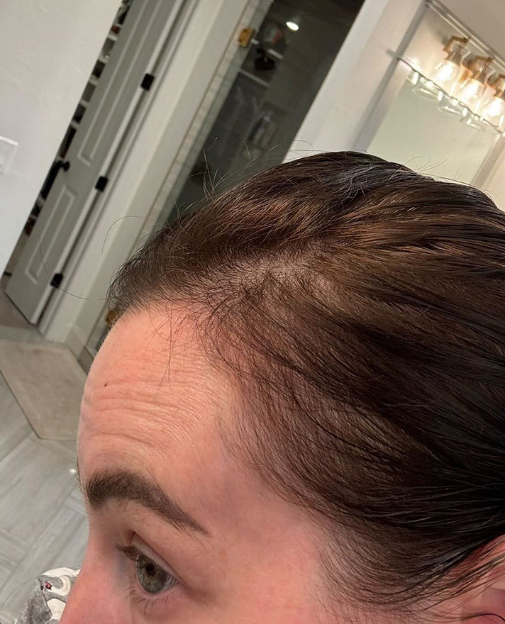 after: the same customer's hairline before and after using Bloom